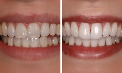 Teeth Bonding Before and After