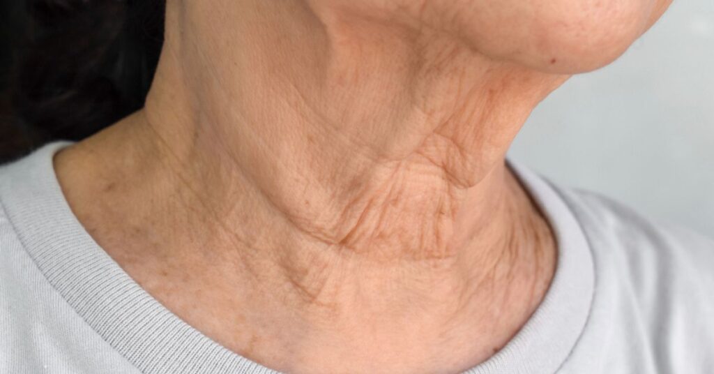 Deep Wrinkles with RF Microneedling