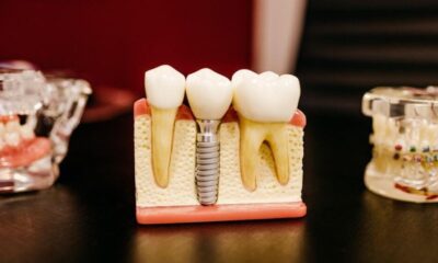 Full-Mouth Dental Implants