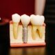 Full-Mouth Dental Implants