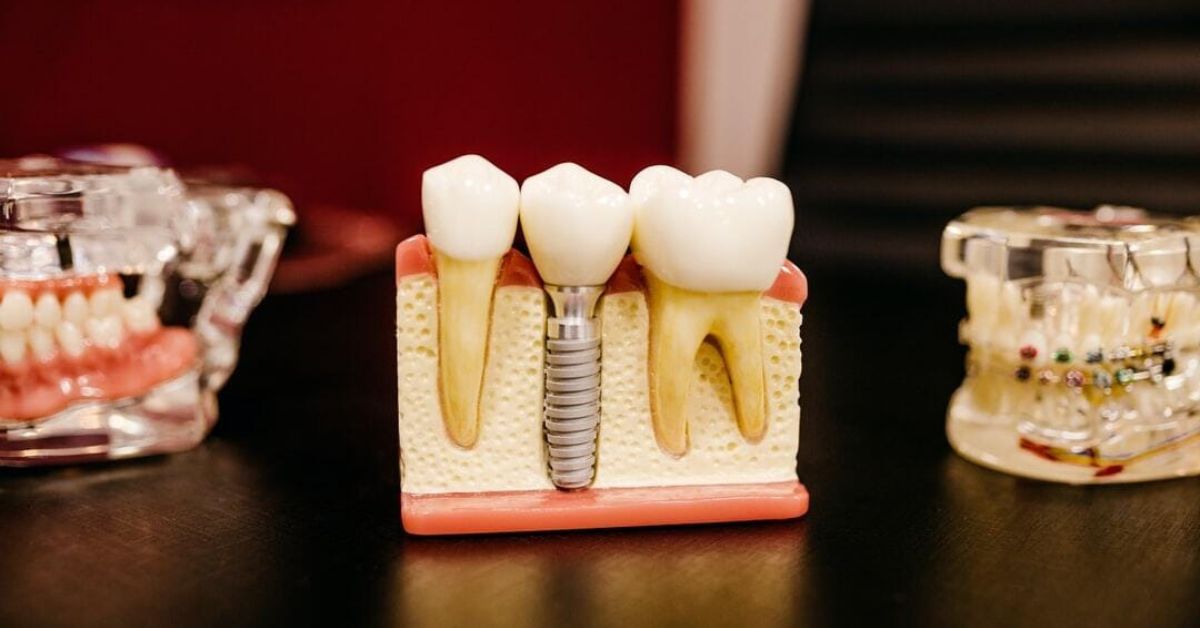 Full-Mouth Dental Implants