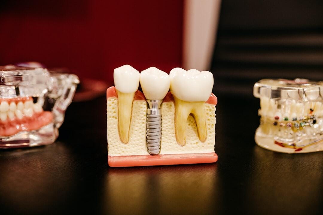 One Tooth Implant